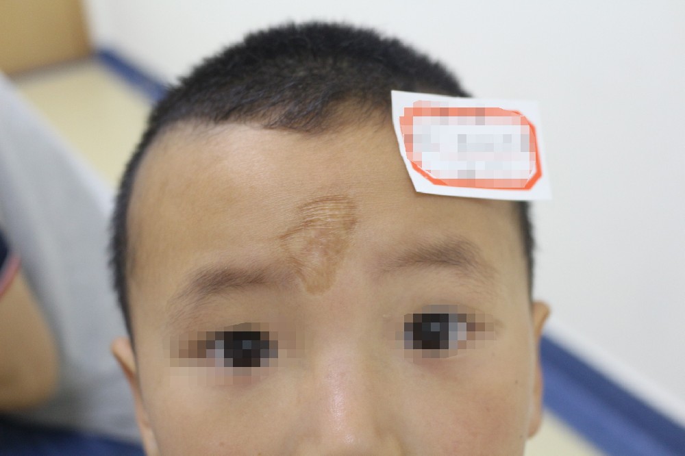 1治疗前..JPG